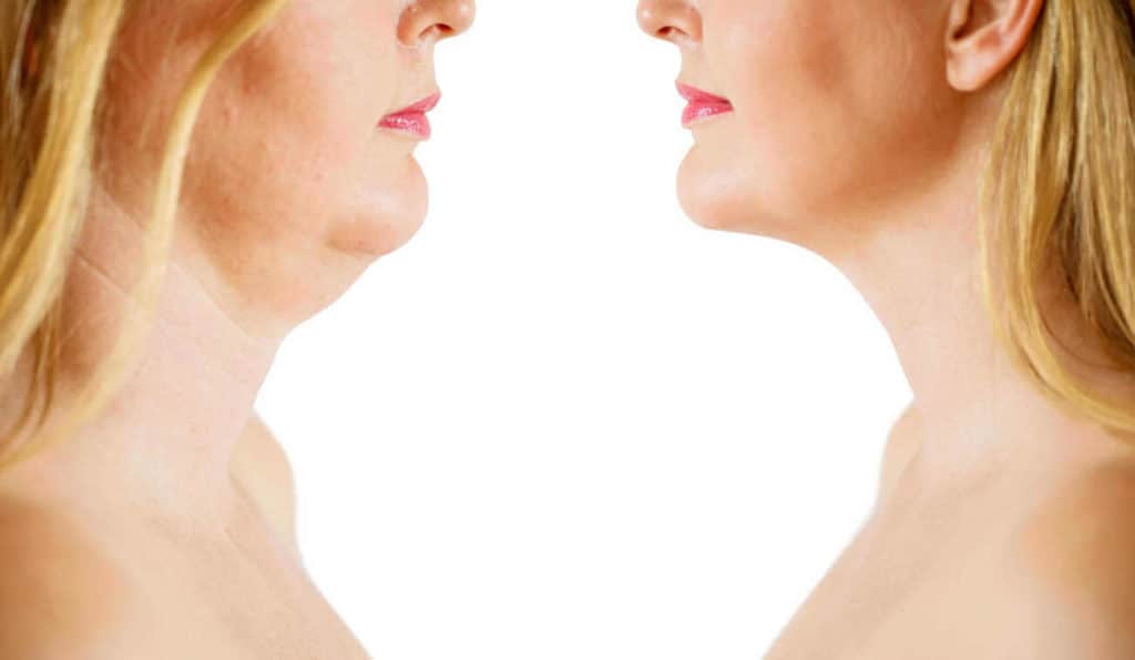 Double Chin treatment Oldham before and after results