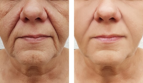 Learn more about Morpheus8 Treatment Oldham today!