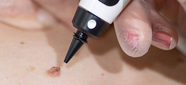 After Skin Tag Removal Oldham