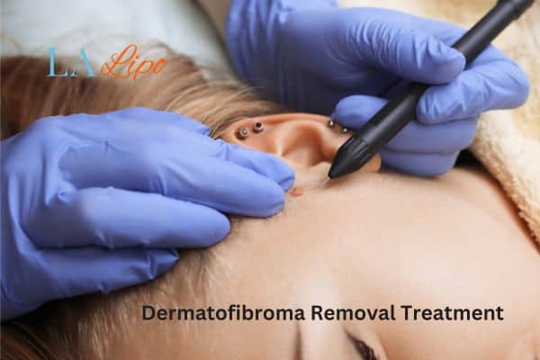Dermatofibroma Removal Treatment Oldham