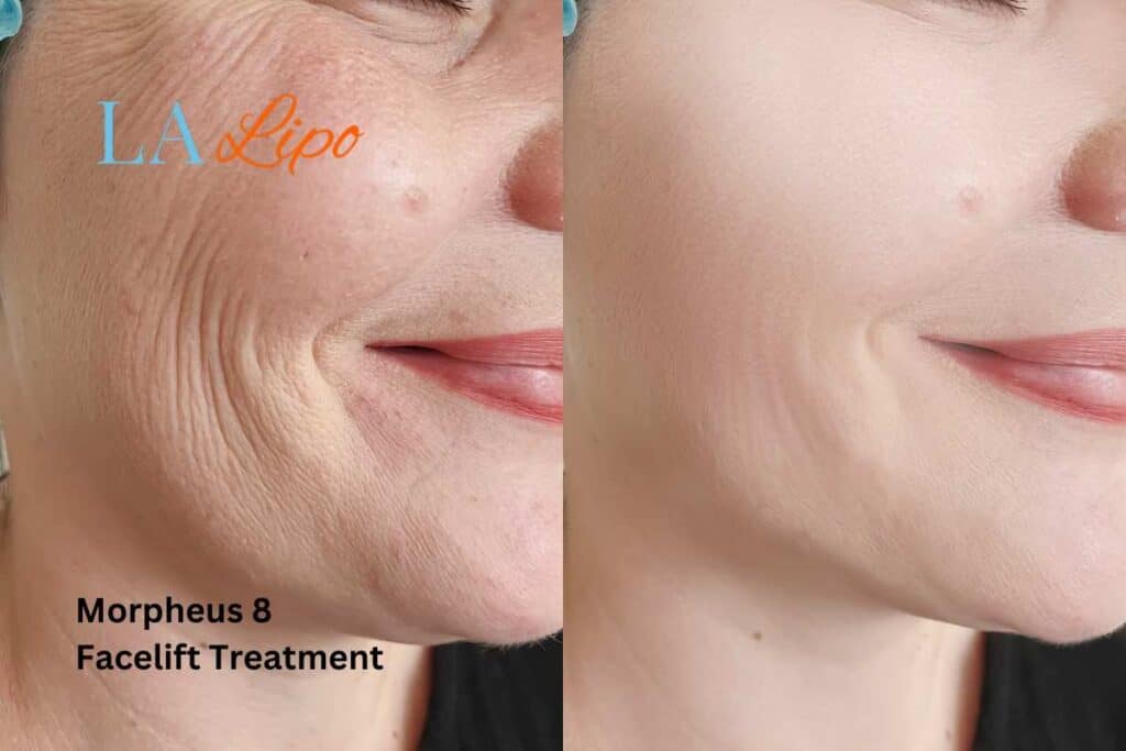Morpheus8 Treatment Oldham for flawless skin! Call us today!