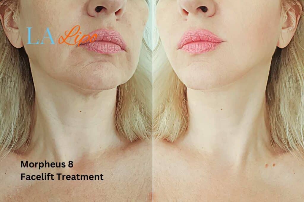 Turn back time with Morpheus8 Treatment Oldham