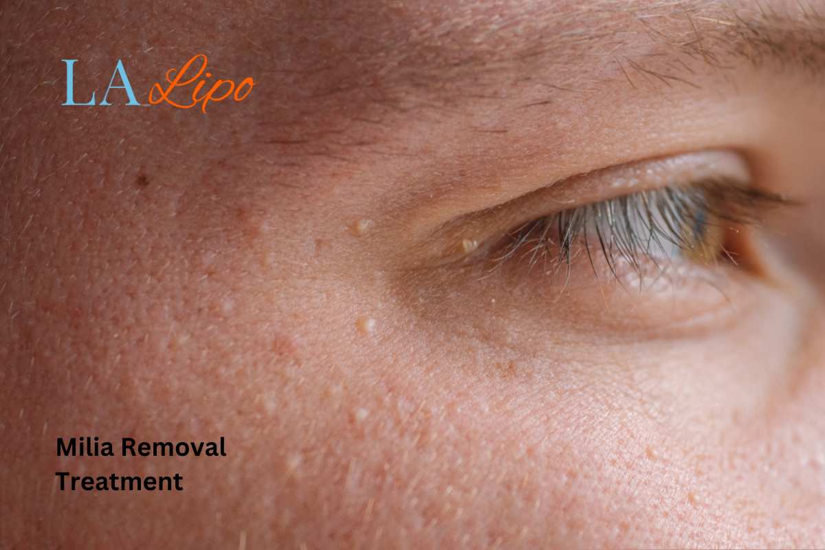 Cryopen Milia Removal: Is It the Easiest and Safest Option Oldham?