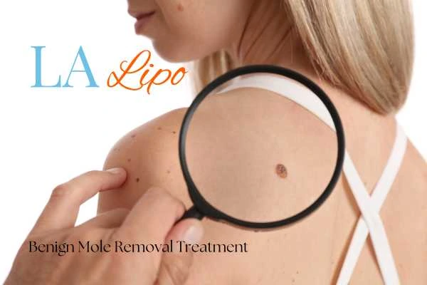 Woman having her inspection of blemish before mole removal Oldham