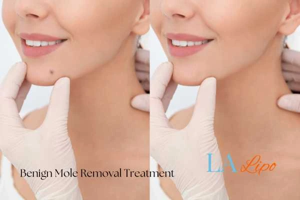 Before and after mole removal Oldham treatment