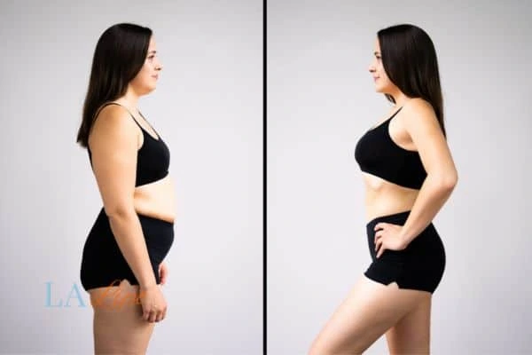 image of woman before and after results of LA-EMS Body Sculpting Oldham to help treat Diastasis recti