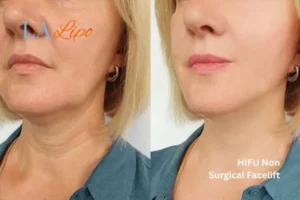 hi-fu for wrinkles Oldham before and after results