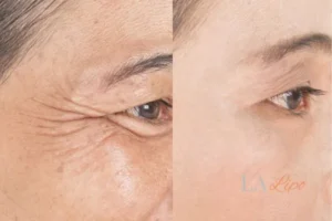 Before and after results of woman - HI-fu wrinkles reduction treatment Oldham