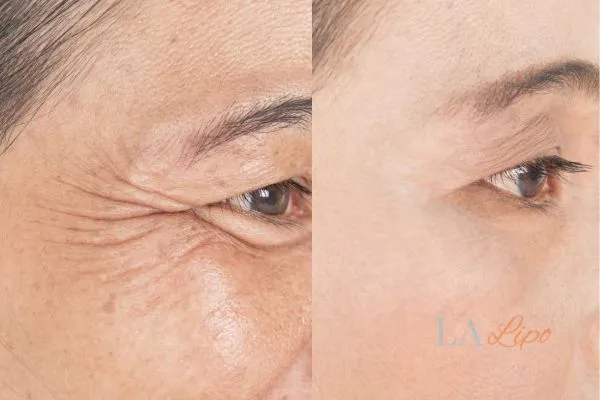 Before and after results of woman - HI-fu wrinkles reduction treatment Oldham
