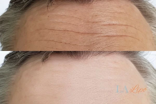 results of HIFU Oldham on mans forehead to help reduce lines and wrinkles