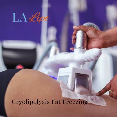 fat freezing - Cryolipolysis Oldham