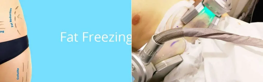 multi areas of a persons body having coolsculpting Oldham treatment