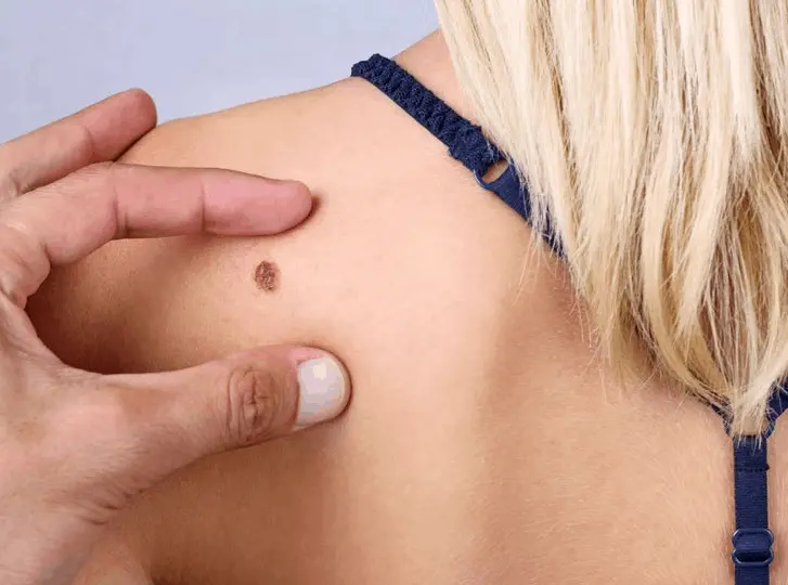 woman having mole removal Oldham consultation before treatment.