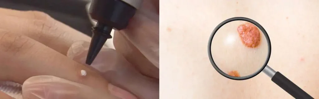 Cryopen for mole removal Oldham - speak to our team today!
