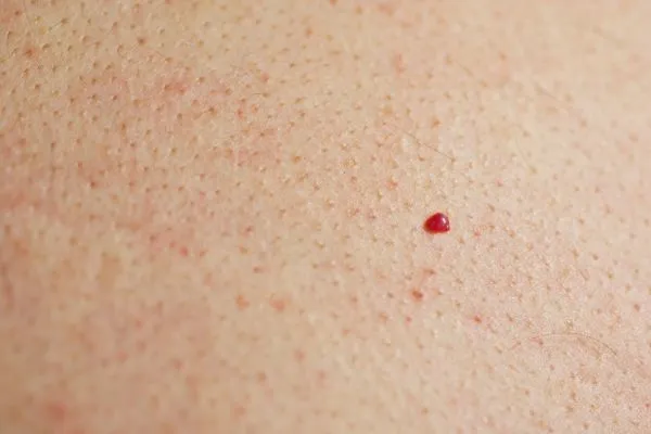 close up of a cherry angioma Oldham