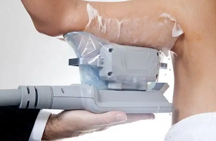 Picture of fat freezing Oldham on the upper arms.