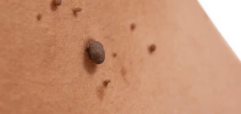 image of a skin tag Oldham