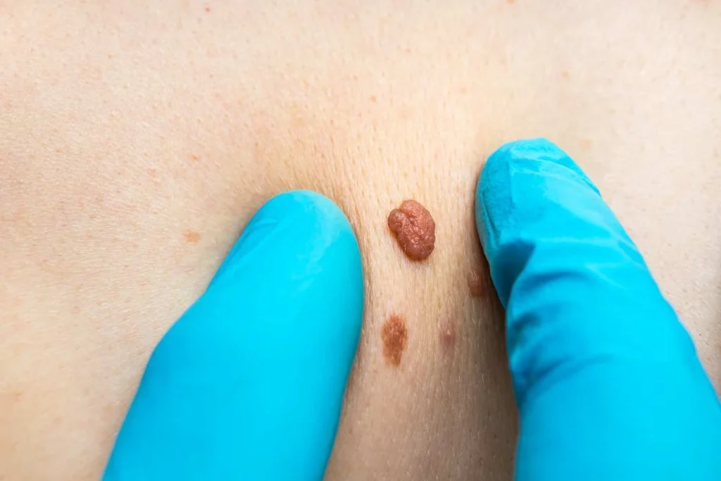 Consultant examining a skin tag Oldham