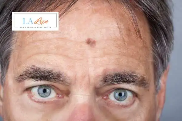 Solar Lentigo Removal Oldham image of man with mark on his forehead