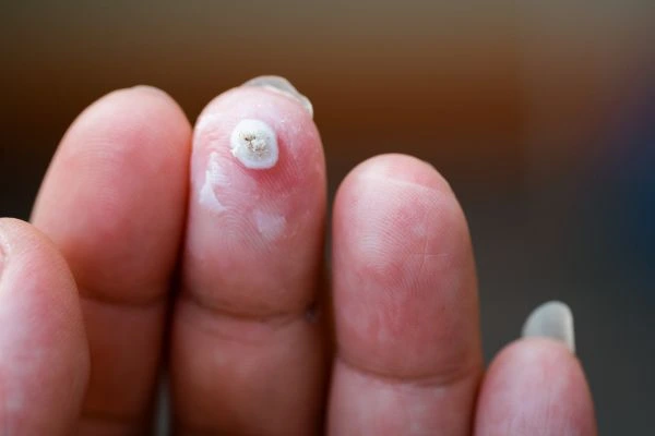 wart on person finger - cryotherapy to treat from LA LIPO Oldham