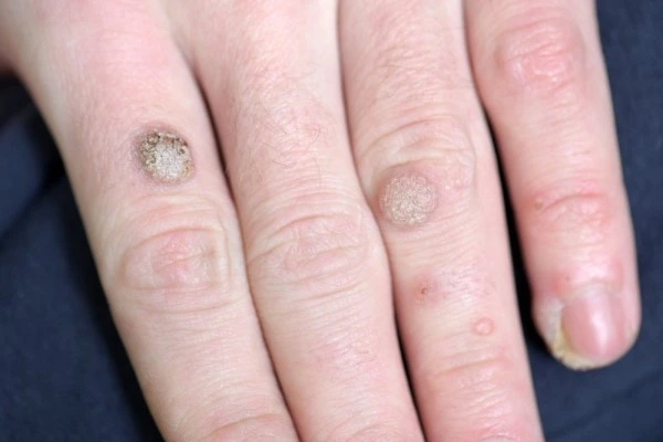 photo of warts on person hand - see wart removal Oldham from LA LIPO