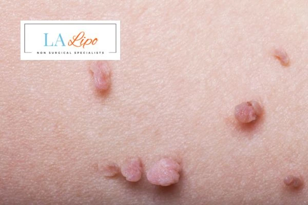 Does cryopen skin tag removal Oldham hurt? Find out now call our team today!