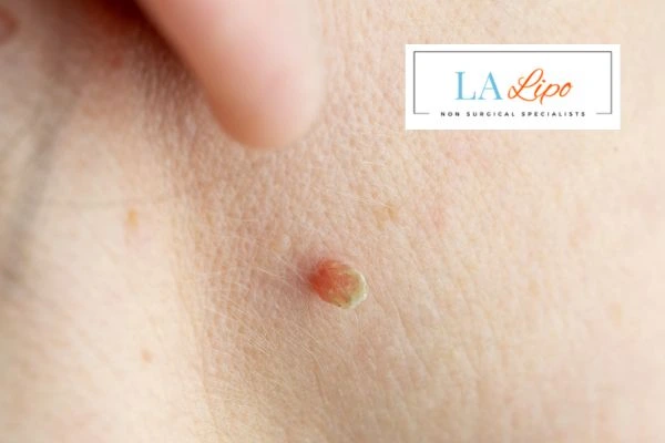 Book skin tag removal Oldham today speak to our team now!