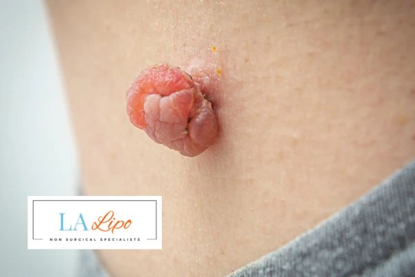 Interested in skin tag removal Oldham? Concerned about the pain? Find out more today!