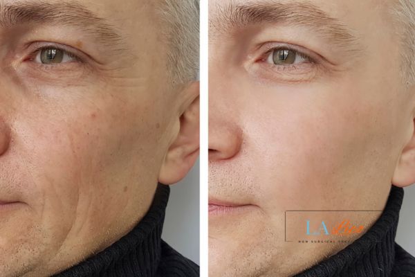 See the amazing results of Morpheus8 Treatment Oldham!