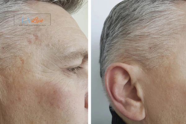 Mens Before & After Morpheus 8 Results Oldham