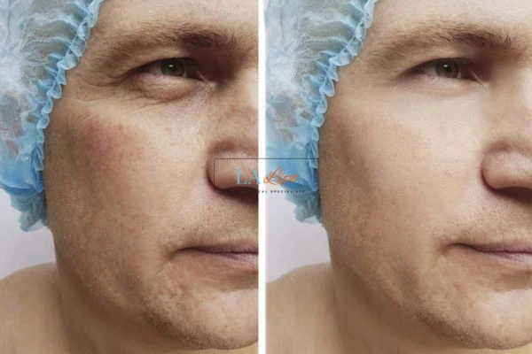 Before and after Morpheus 8 Results Oldham
