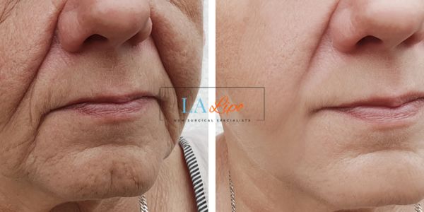 Older lady deeper wrinkle reduction - LA LIPO Morpheus 8 Results Oldham