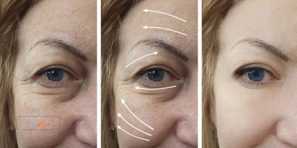 Amazing eye lift Morpheus 8 results Oldham