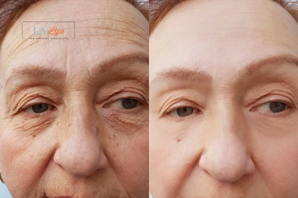 The powerful benefits of Morpheus8 Treatment Oldham - Call Our team today!