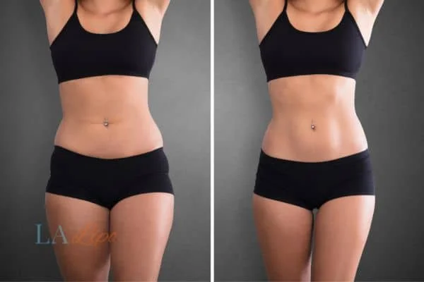 before and after results of non-surgical treatment to help a woman's body image and mental health Oldham