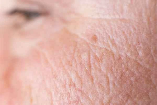 close up picture of a woman's face showing an age spot Oldham