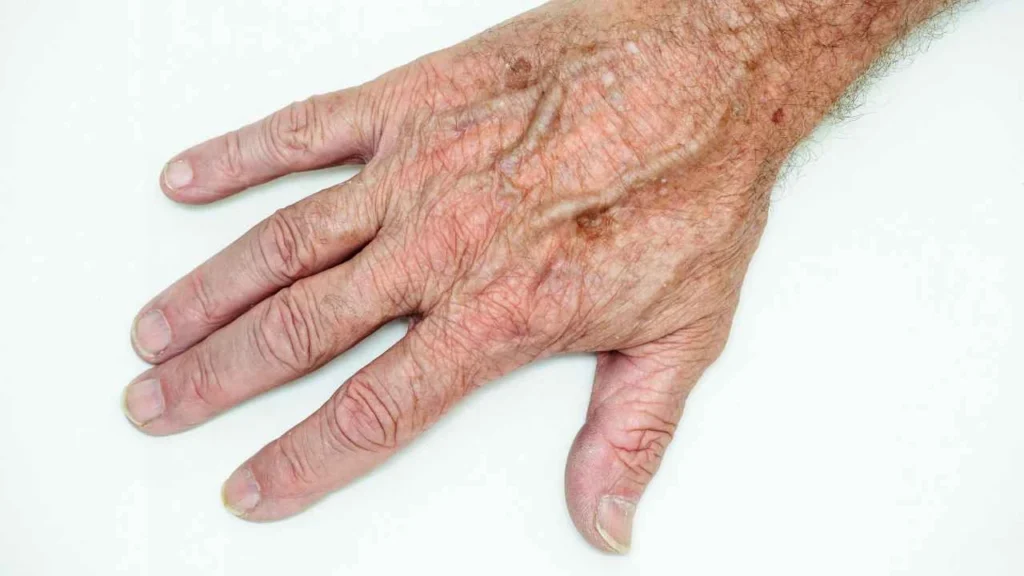Male hand showing age spot Oldham