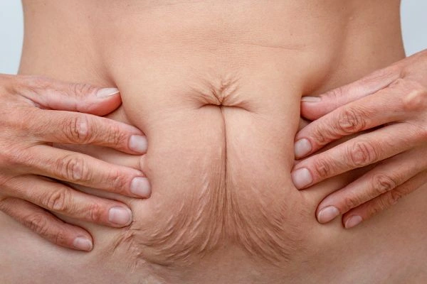 Image of a woman's stomach with loose skin - example of skin tightening Oldham options