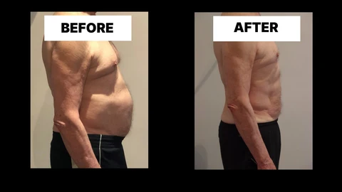 What Symptoms Can Diastasis Recti Cause in Men? Weak Core, Back Pain and Poor Posture Oldham